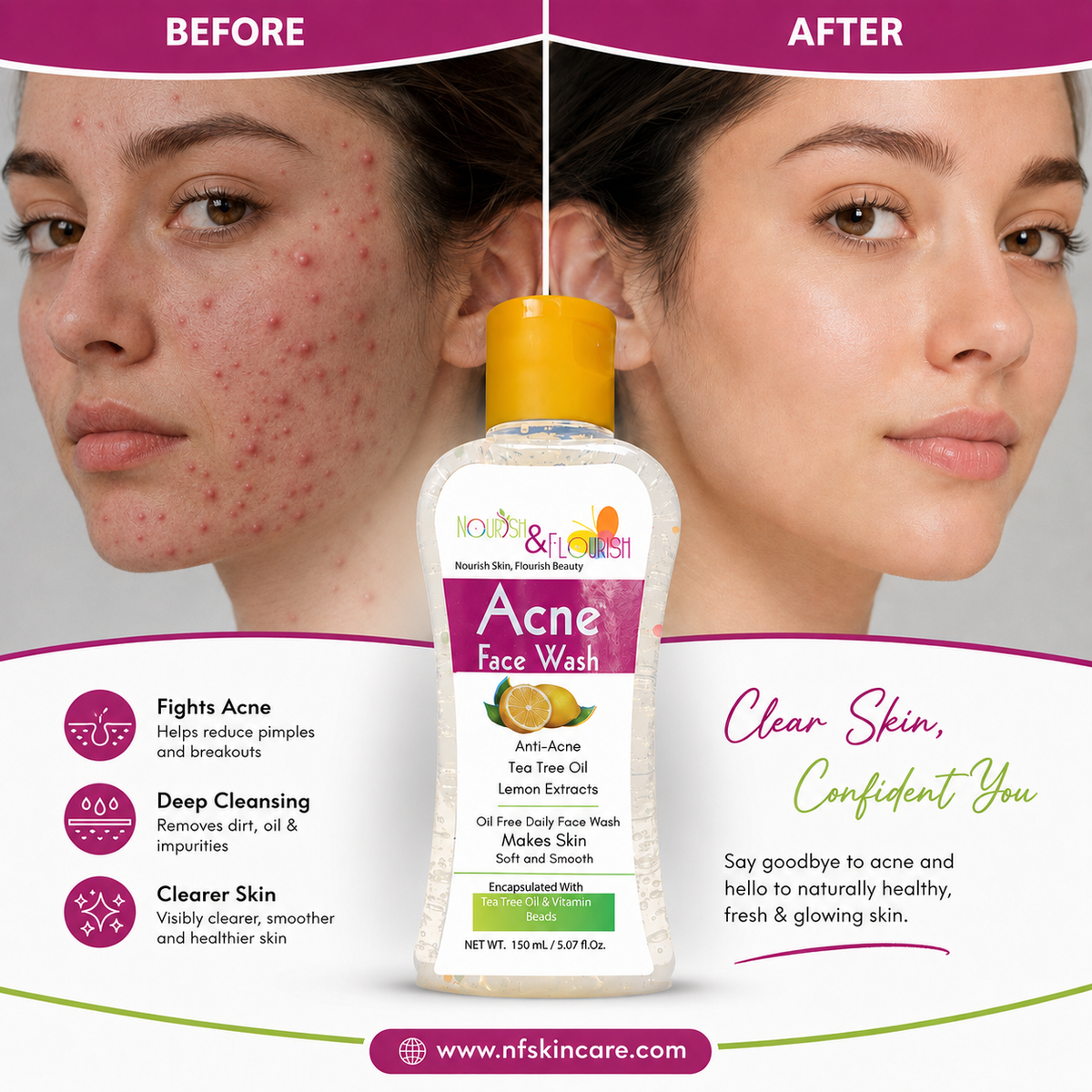 Nourish & Flourish Acne Face Wash - No More Black Heads & Pimples on Face