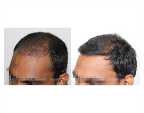 Hair loss spray for regrowth hairs