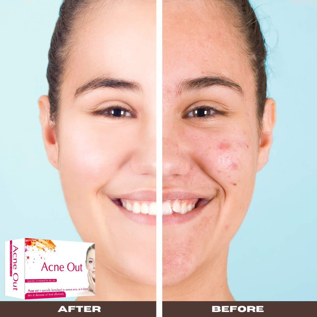 Acne out soap deals