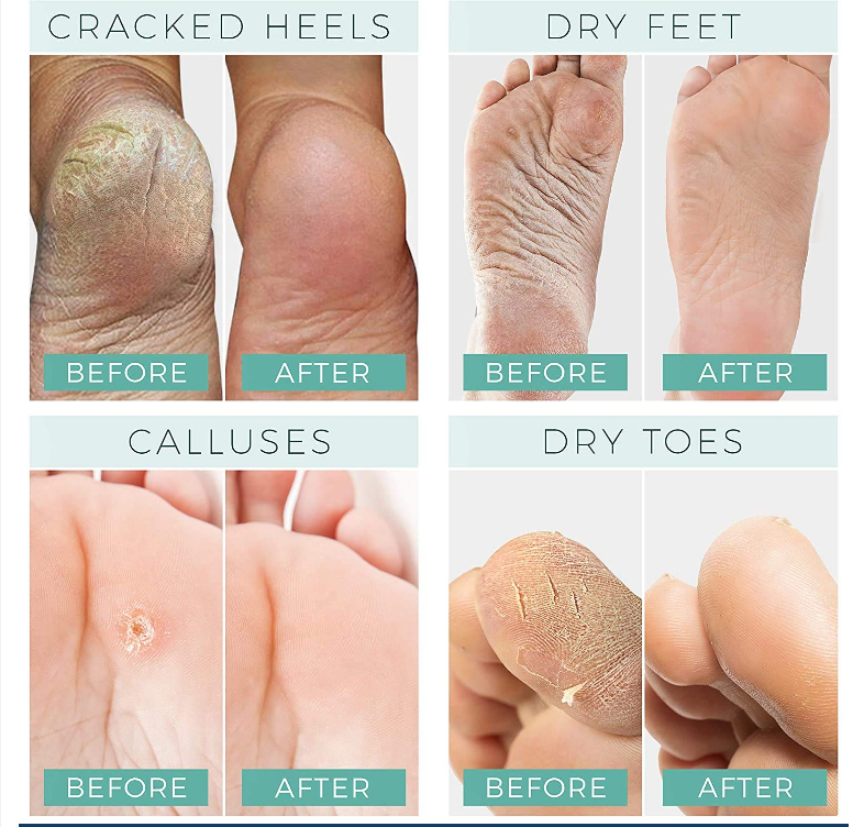 Foot Repair Cream - Cracked Heels - Callus Removal - Baby like Soft Feets